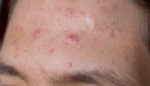 Can I get a massage if I have really bad acne on my back?